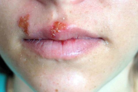 Home Remedies to get rid of cold sores