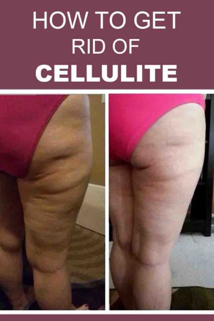 How to Get Rid of Cellulite Fast?