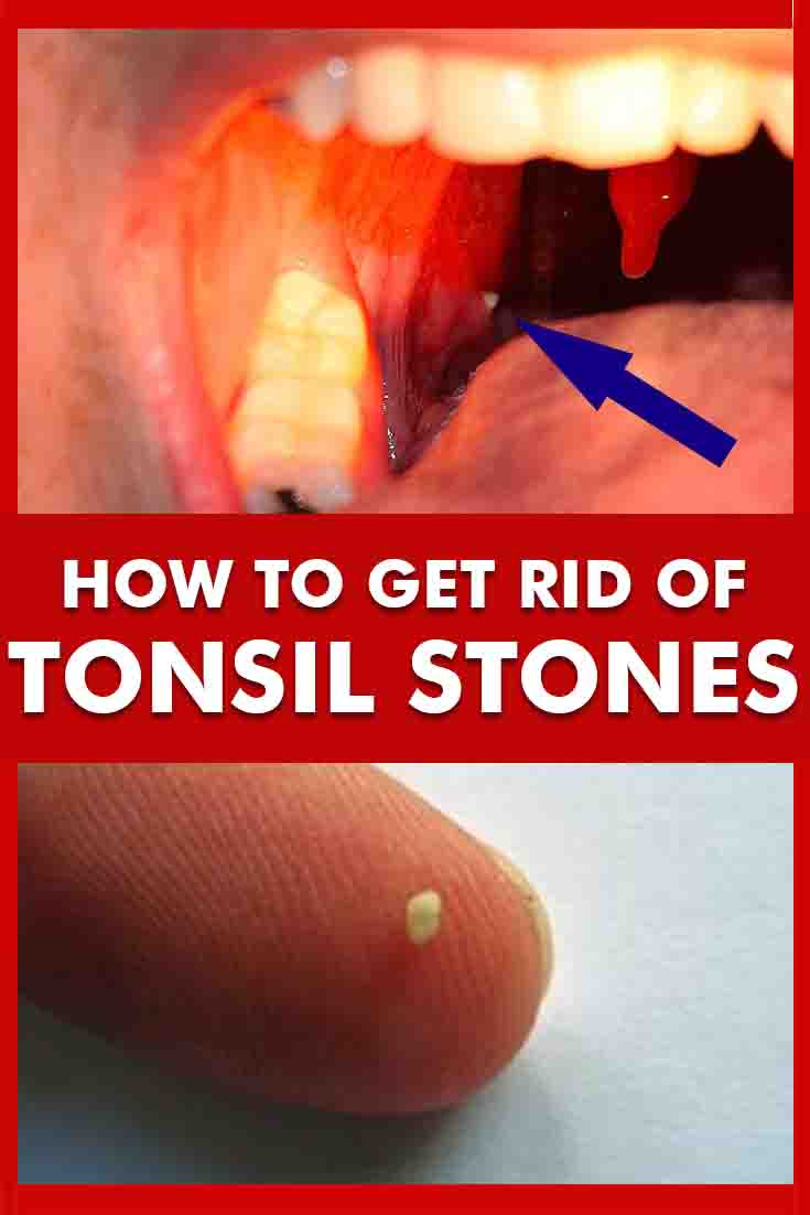 How to Get Rid of Tonsil Stones?