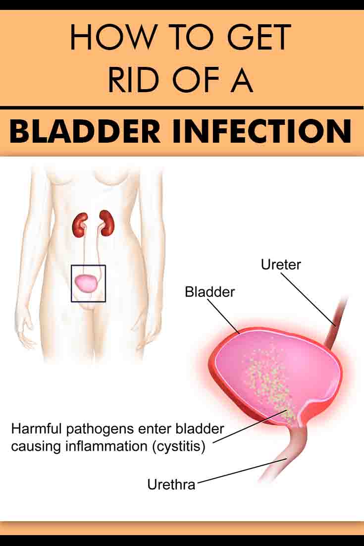 How to Get Rid of a Bladder Infection?