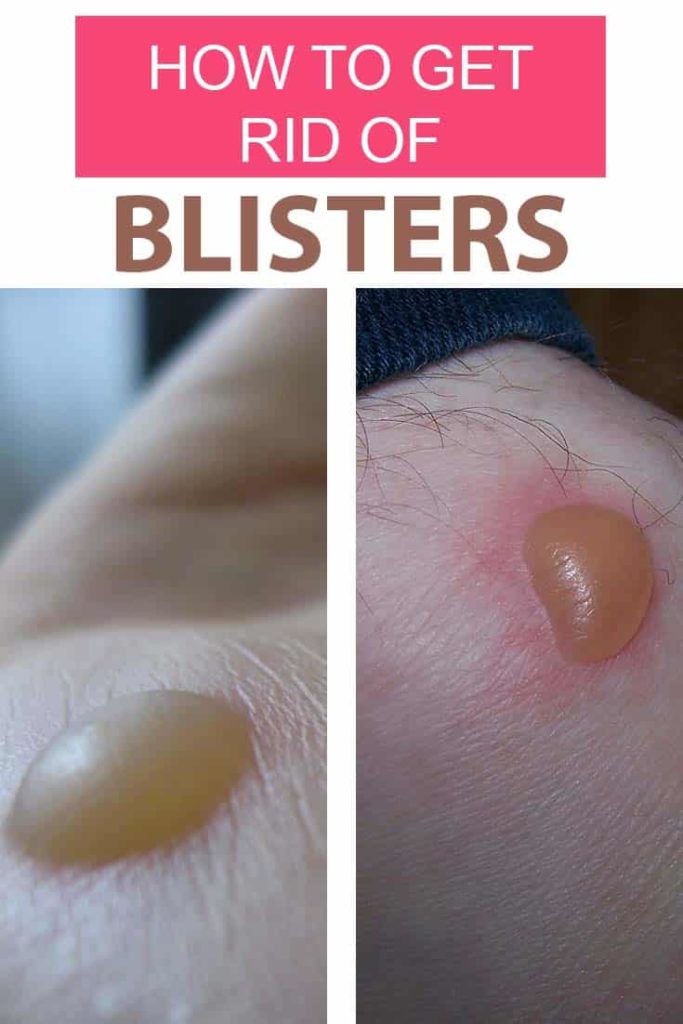 How To Get Rid Of Blisters Fast Home Remedies For Blisters 9751