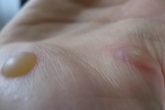 How To Get Rid Of Warts At Home?