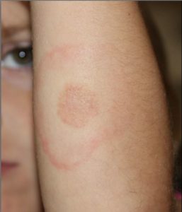 How to get rid of ringworm