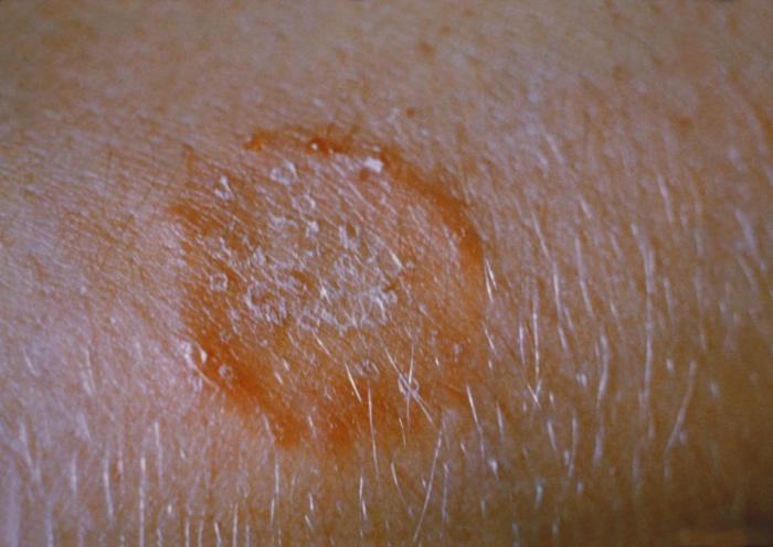 How To Get Rid Of Ringworm With Home Remedies?