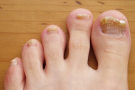 how to get rid of toenail fungus