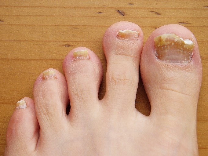 How to Get Rid of Toenail Fungus with Easy Home Remedies?
