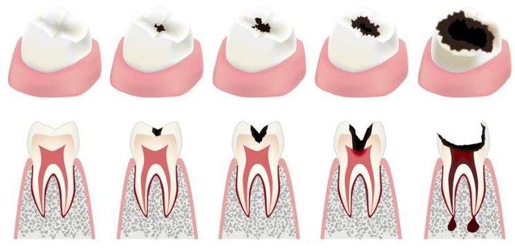 Use These Home Remedies for Cavities to Get Rid of It at Home