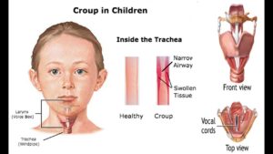 Home remedies for croup