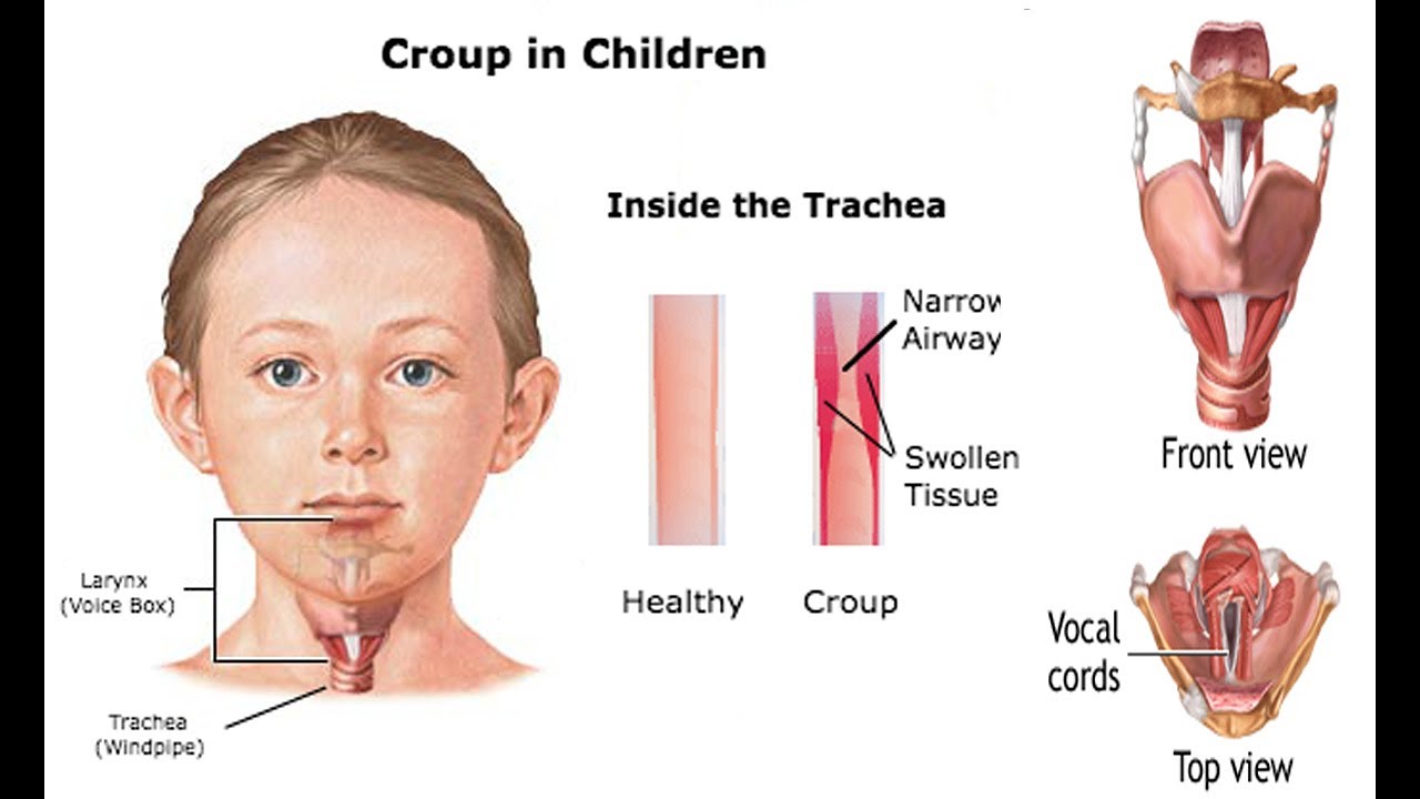 How to Get Rid of Croup?; 6 Home Remedies for Croup