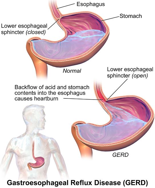 Try These Top 6 Home Remedies for Gastritis for Instant Relief