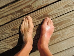 Home remedies for gout