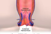 Home remedies for hemorrhoids