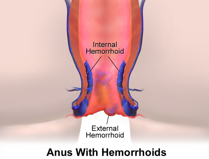 10 Home Remedies for Hemorrhoids: How to Get Rid of Hemorrhoids?