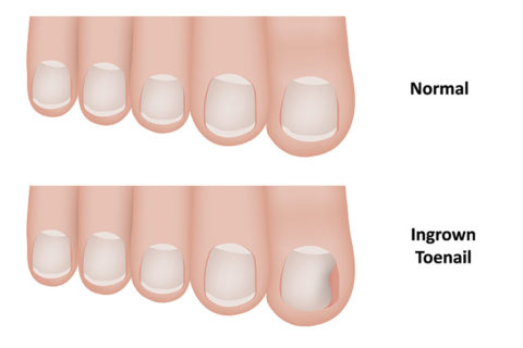 Home remedies for ingrown toenail