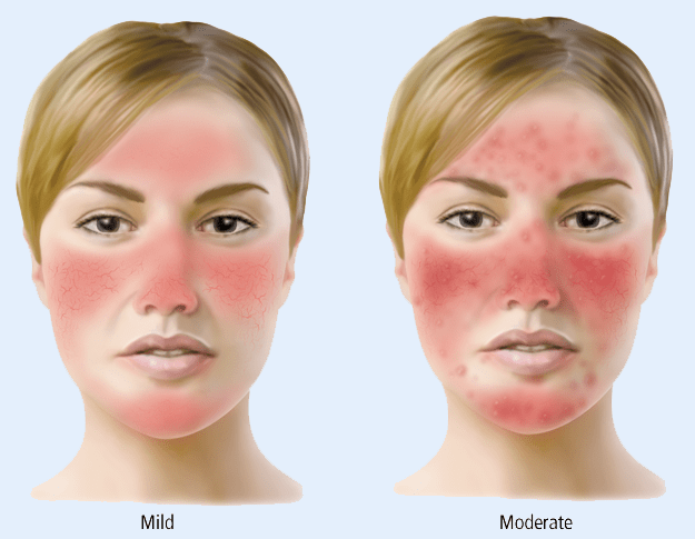 Top 6 All-Natural and Cost Effective Home Remedies for Rosacea