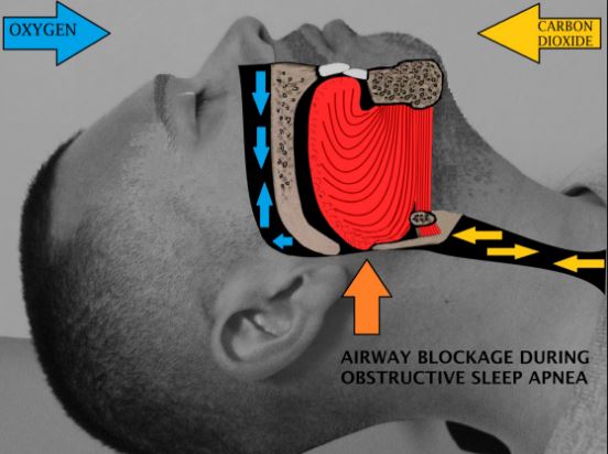 6 Sure-Fire Home Remedies for Sleep Apnea to Help You Sleep Better