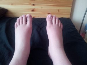 Home remedies for swollen feet