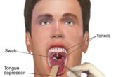 Home remedies for tonsillitis