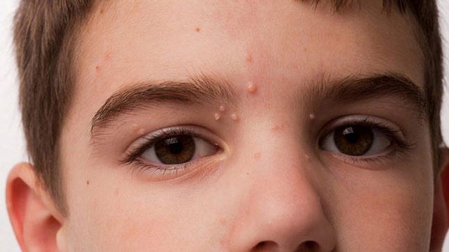 Molluscum Contagiosum Home Remedy That You Should Try