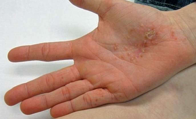 6 Home Remedies for Dyshidrotic Eczema to Keep It Under Control