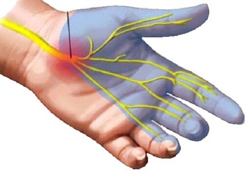 8 Effective Home Remedies for Carpal Tunnel Syndrome