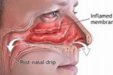 How to stop post nasal drip