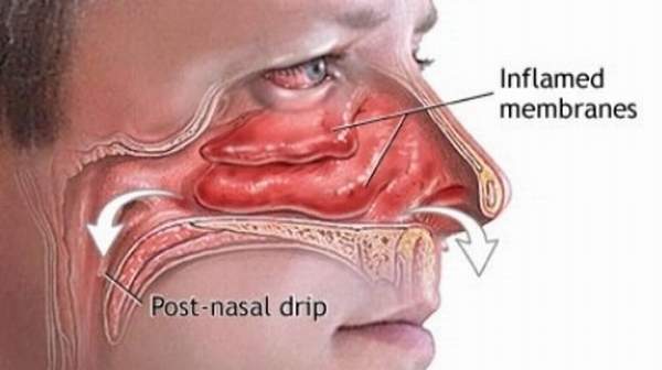 How to stop post nasal drip