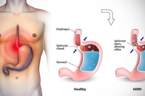 How to treat gastric distress