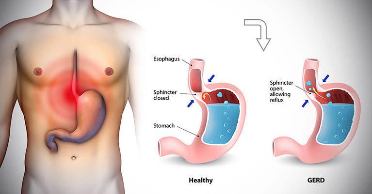 How DNA Test Can Help Unfold The Reason For Gastric Distress!