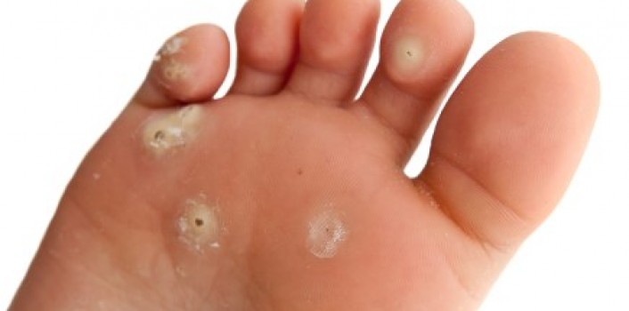 How to Get Rid of Plantar Warts?: 10 Home Remedies for Plantar Warts