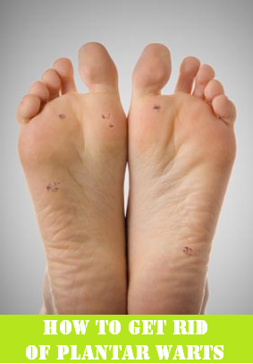 How to get rid of plantar warts