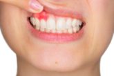 Get rid of swollen gums