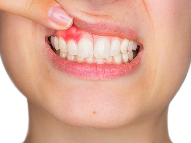 Get Rid of Swollen Gums with 10 Easy Yet Effective Home Remedies