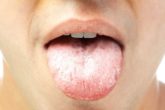 How to get rid of white tongue