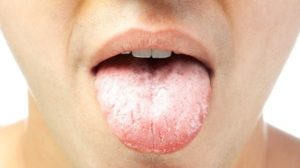 How to get rid of white tongue