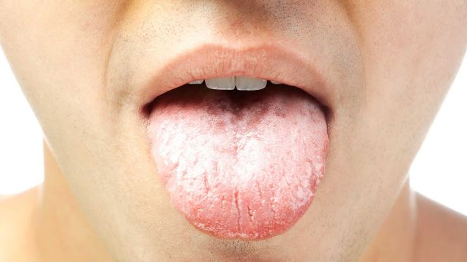 10 Home Remedies to Help You Get Rid of White Tongue Naturally