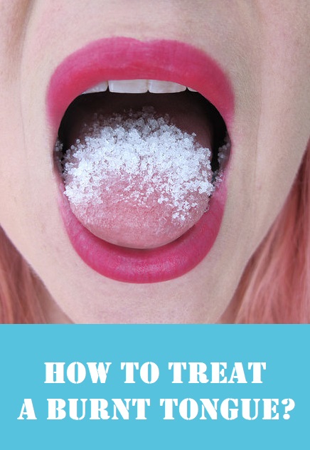 Home remedies for burnt tongue.