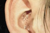 How to get rid of blackheads in ears