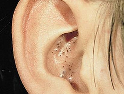 8 Simple Home Remedies You Can Try to Get Rid of Blackheads in Ears
