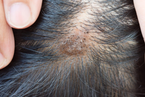 How to get rid of scalp sores