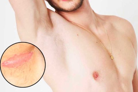 How to get rid of underarm rash