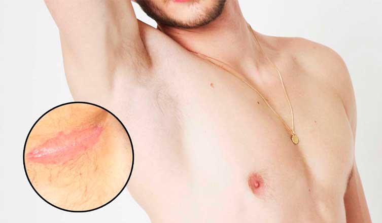 How to get rid of underarm rash