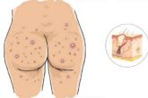 Home remedies for butt acne