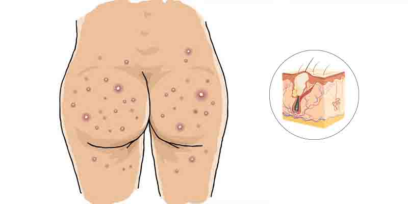 10 Best Home Remedies for Butt Acne With Easily Available Ingredients