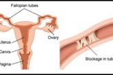 Home remedies for unblocking fallopian tubes