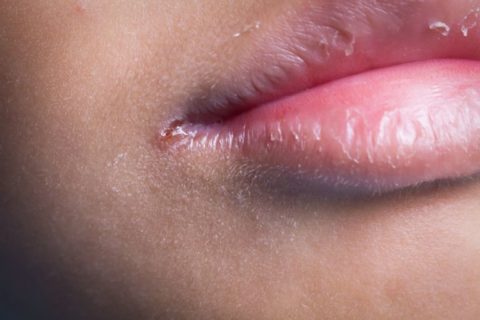 How to get rid of angular cheilitis