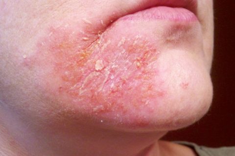 How to get rid of perioral dermatitis
