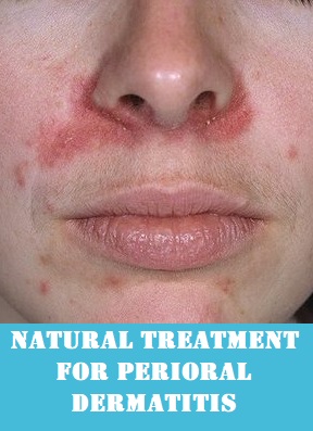 How to get rid of perioral dermatitis