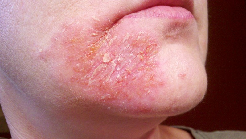 Remedies dermatitis perioral home for How To