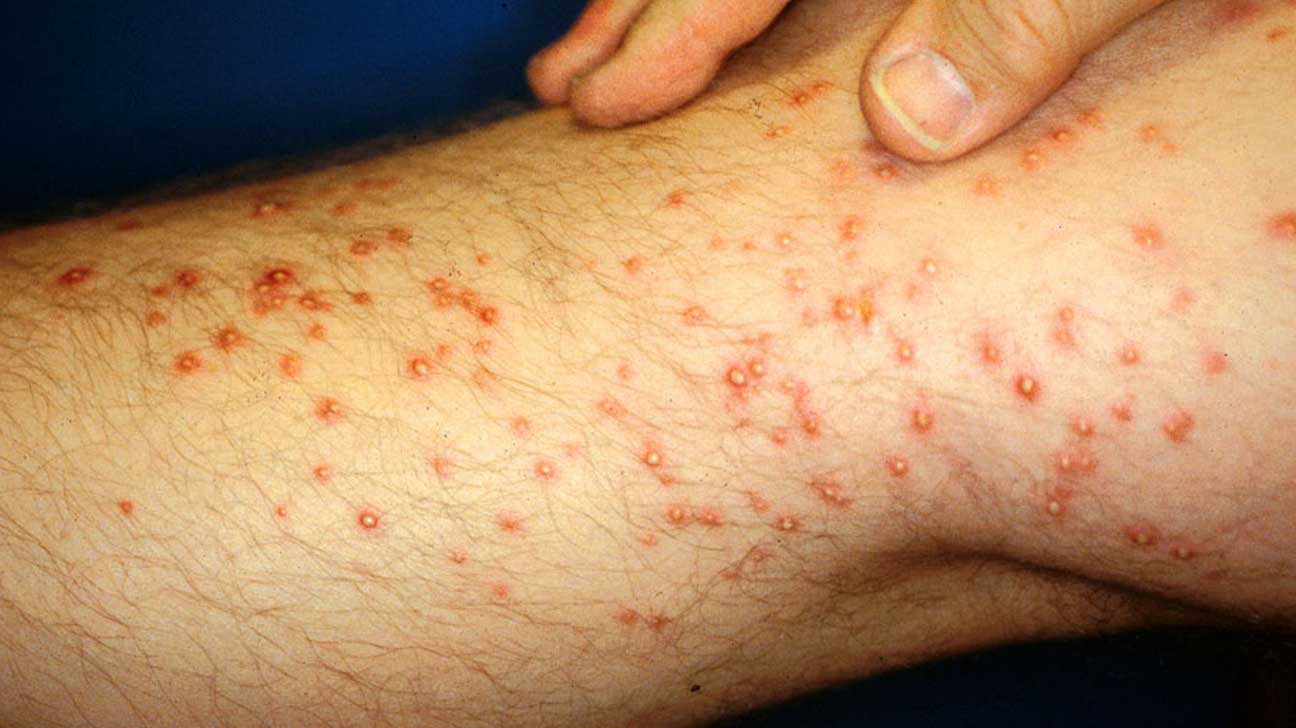 How To Treat Fire Ant Stings 10 Home Remedies To End Your Sting ful 